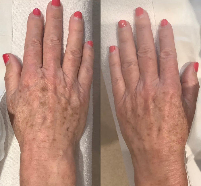 This image demonstrates mole, milia, or other lesion removal at our dermatology clinic in Beckenham. We serve patients from across Kent and Greater London including Petts Wood, Bromley, Sevenoaks, and Orpington.
