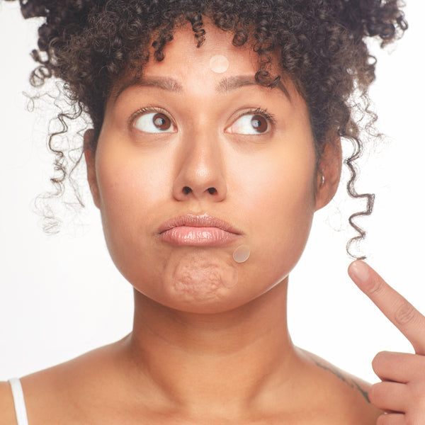 Young woman with curly hair applying clear acne patches to her forehead and chin, demonstrating skincare using the Breakout Box 3-In-1 Acne Treatment Kit | Patchology.