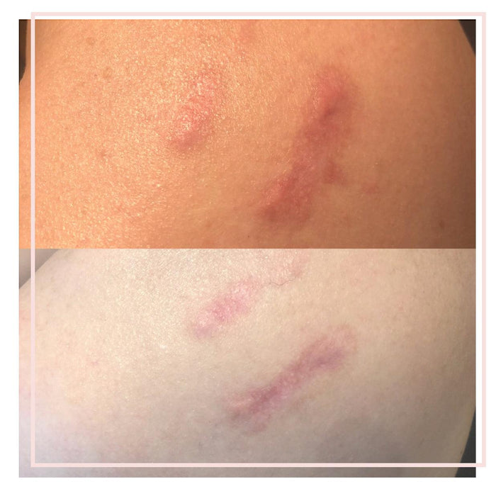 Intra-Lesional Steriod Injections - Emma Coleman Skin