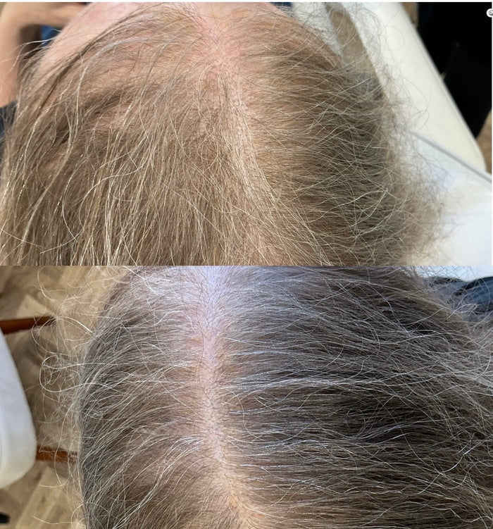 Platelet Rich Plasma Therapy for Face Rejuvenation and Hair Loss (PRP)