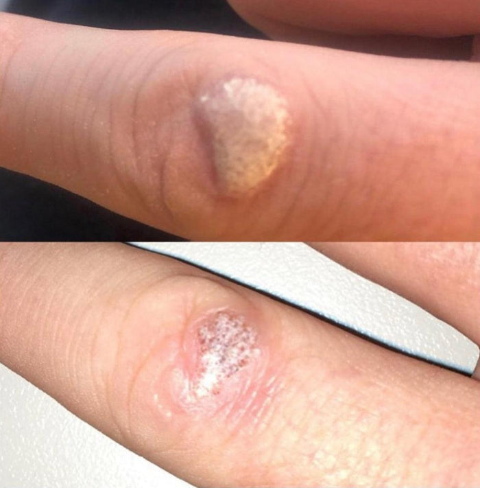 This image demonstrates mole, milia, or other lesion removal at our dermatology clinic in Beckenham. We serve patients from across Kent and Greater London including Petts Wood, Bromley, Sevenoaks, and Orpington.