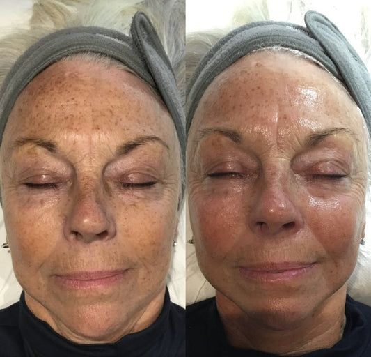 Lynton Illumi Facial - Glycolic Peel and IPL Rejuvenatuon at Emma Coleman Skin, Beckenham, Orpington and Sevenoaks