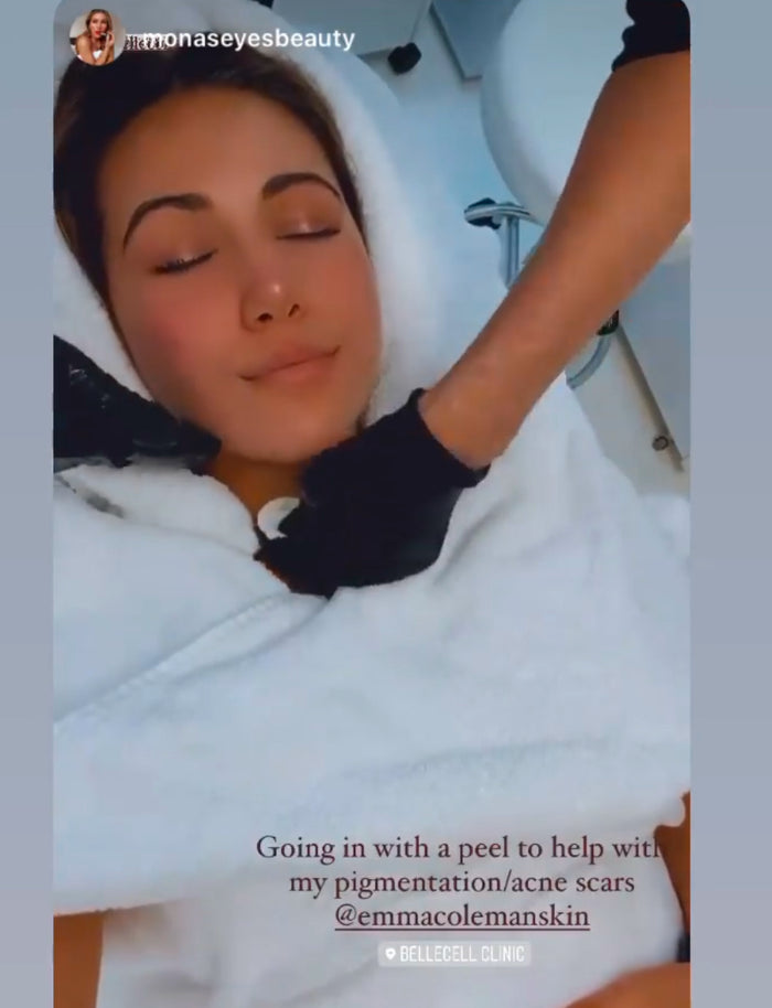 Lynton Illumi Facial - Glycolic Peel and IPL Rejuvenation at Emma Coleman Skin, Beckenham, Orpington and Sevenoaks