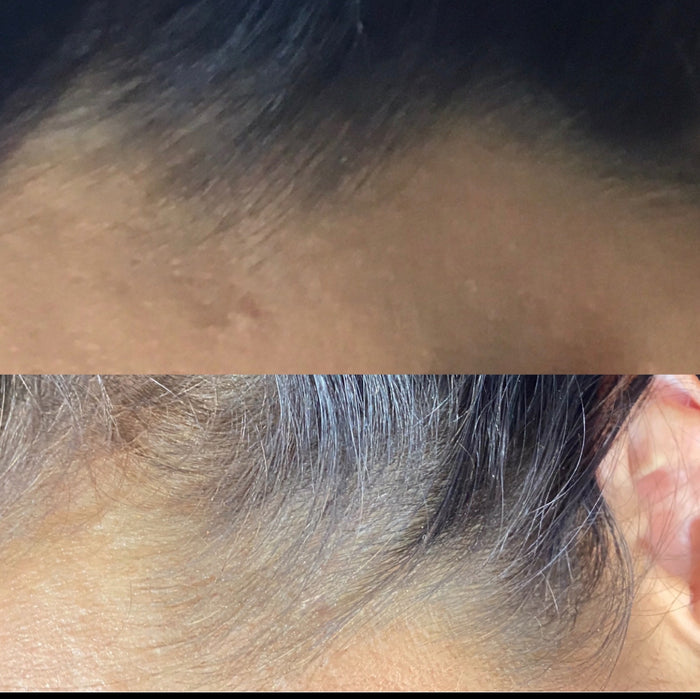 Platelet Rich Plasma Therapy for Face Rejuvenation and Hair Loss  (PRP)