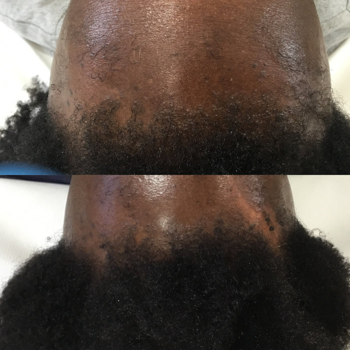 Platelet Rich Plasma Therapy for Face Rejuvenation and Hair Loss  (PRP)